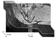 Top: A stack of 15 sagittal images of the IT used to measure the thickness of the muscle, fat and skin overlying the IT.  The center image contained the IT tip and was used as a reference point for the other 7 lateral and 7 medial images.